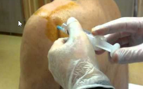تزریق PRP