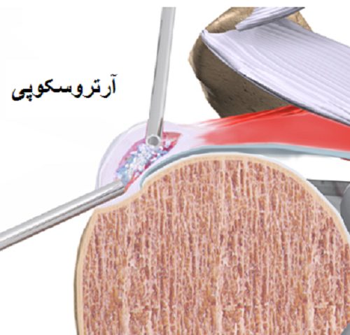 رزکسیون آرتروسکوپی